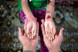 Epidermólise Bolhosa: doença rara causa dores e ferimentos ao deixar a pele frágil como asas de borboletas